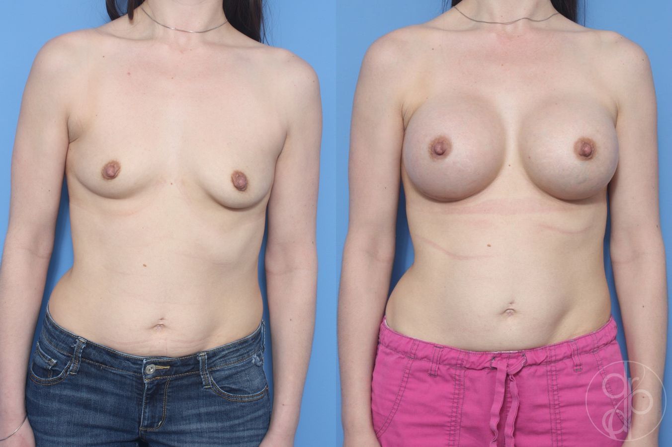 Before and after procedure result