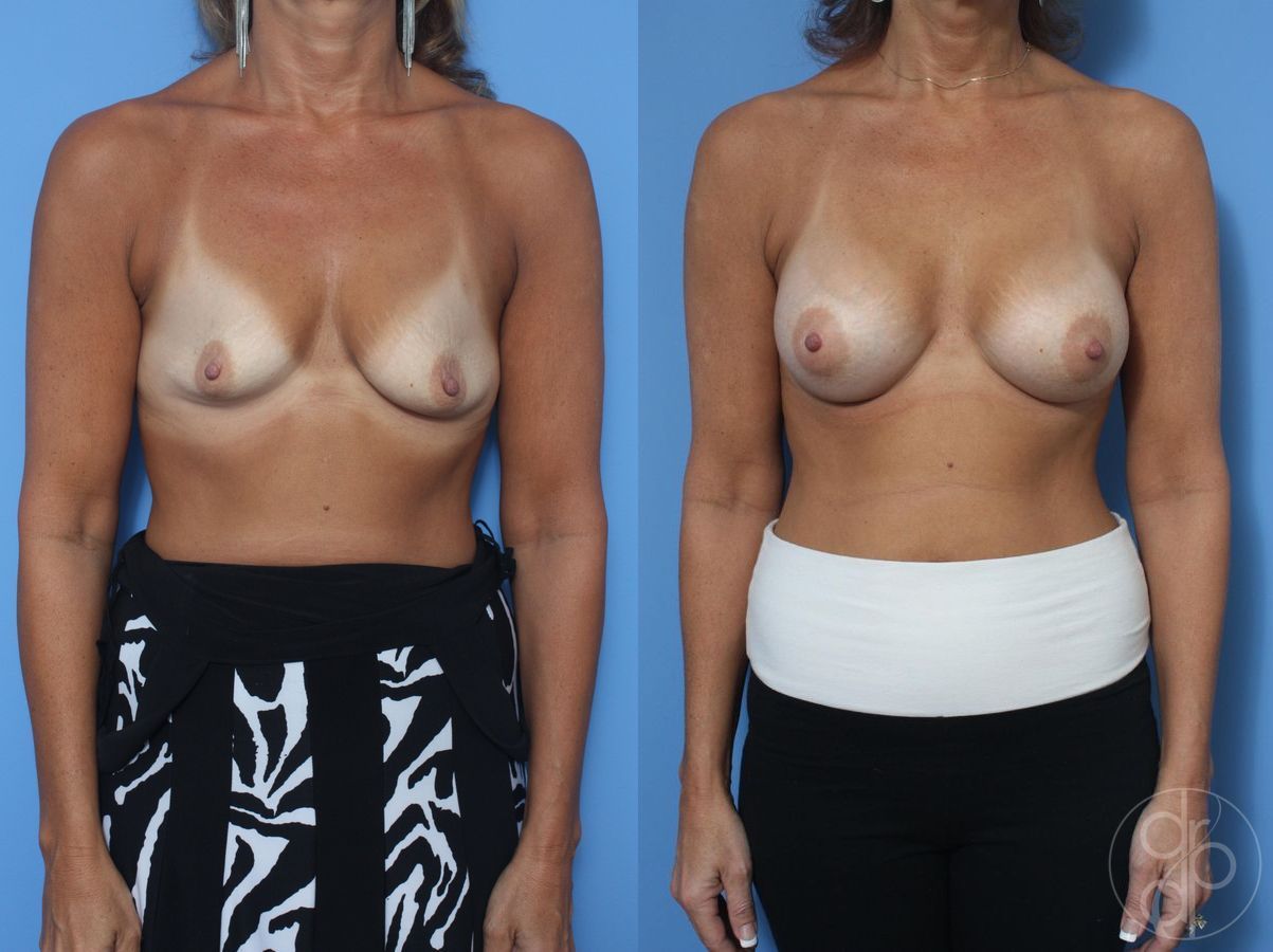 Before and after Breast Augmentation case 29823