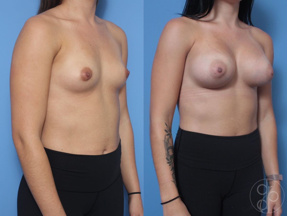 Before and after Breast Augmentation case 29819 - Angle 4