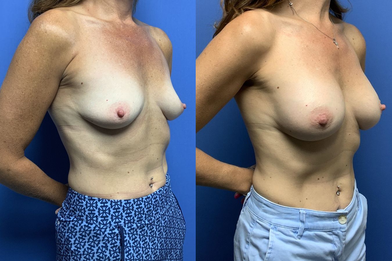 Breast Augmentation - Thumbnail 2