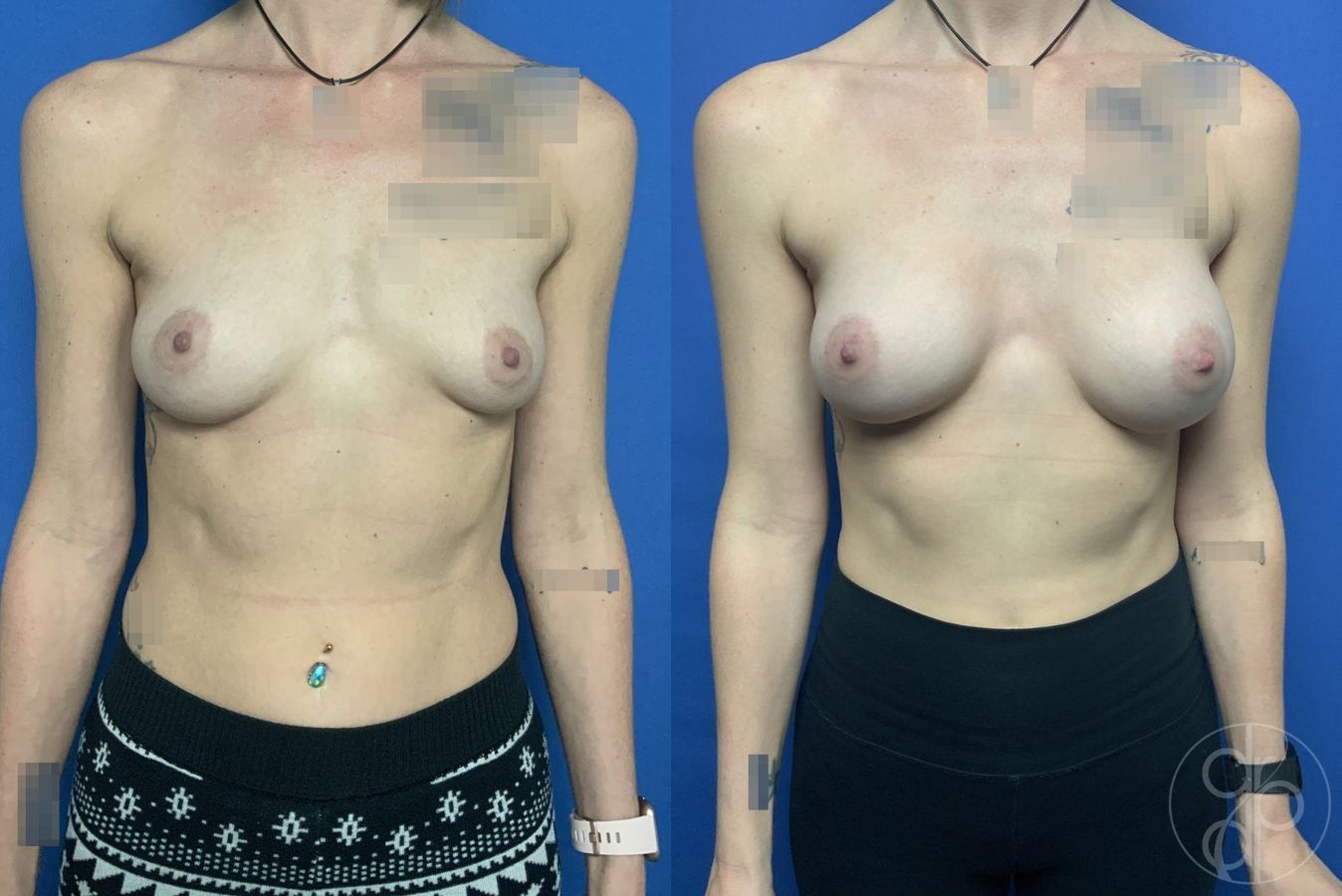 Breast Augmentation - Case 449