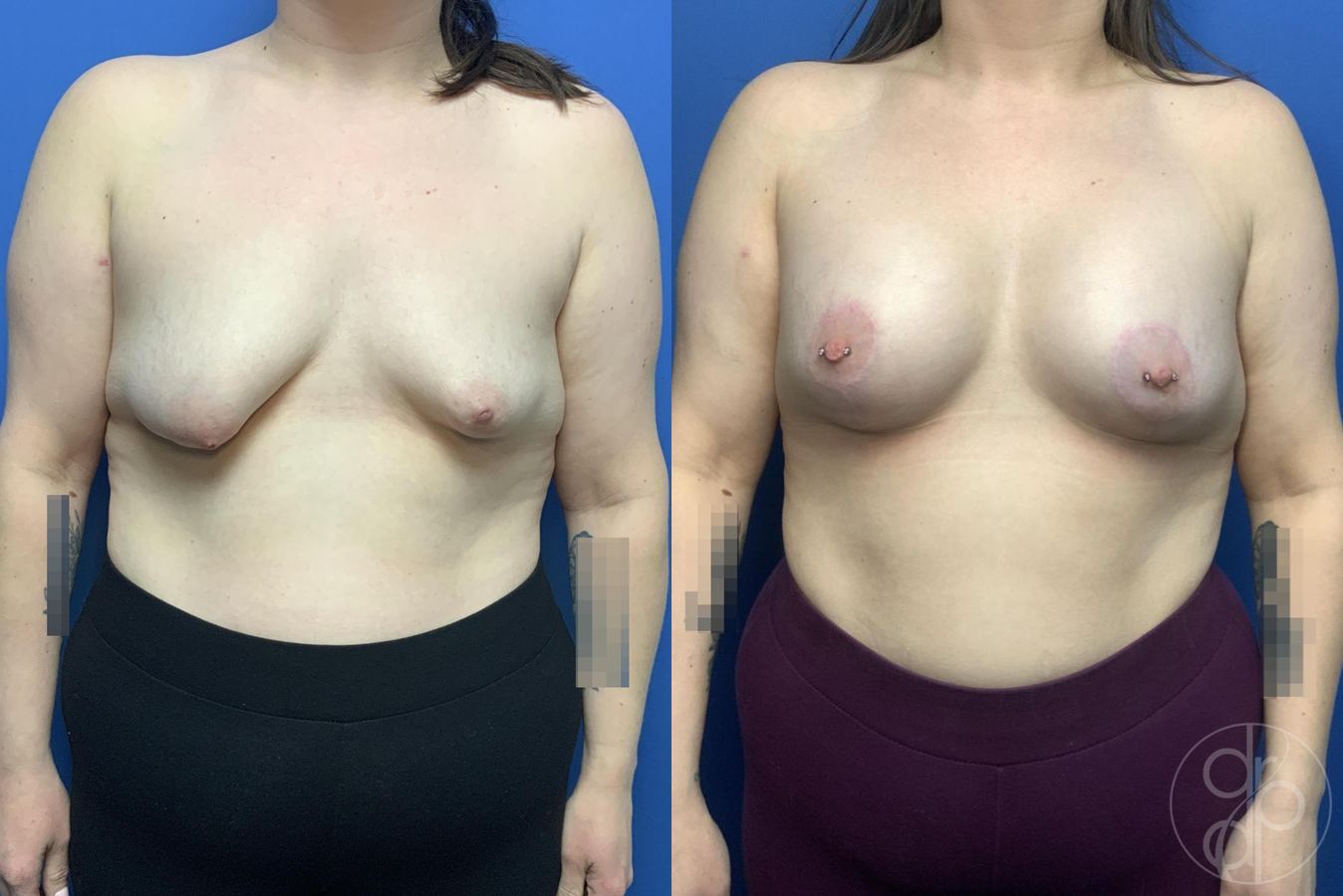 Before and after Breast Lift case 29979