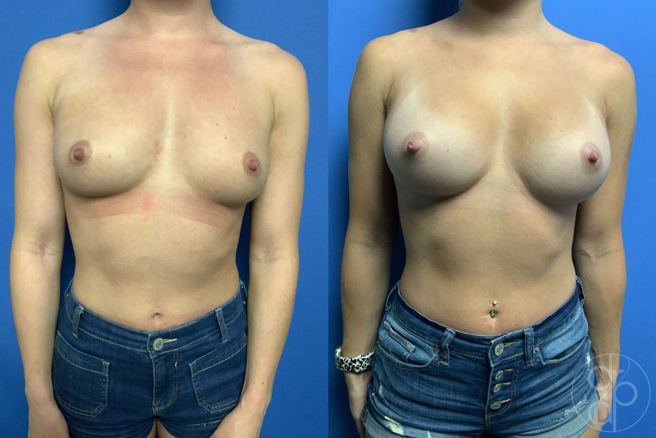 Before and after Breast Augmentation case 29802