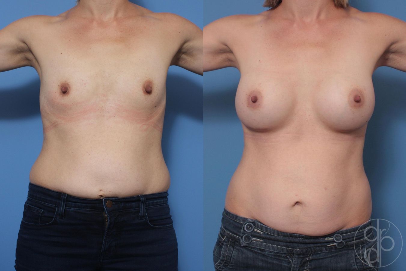 Before and after Breast Augmentation case 29644 - Angle 2