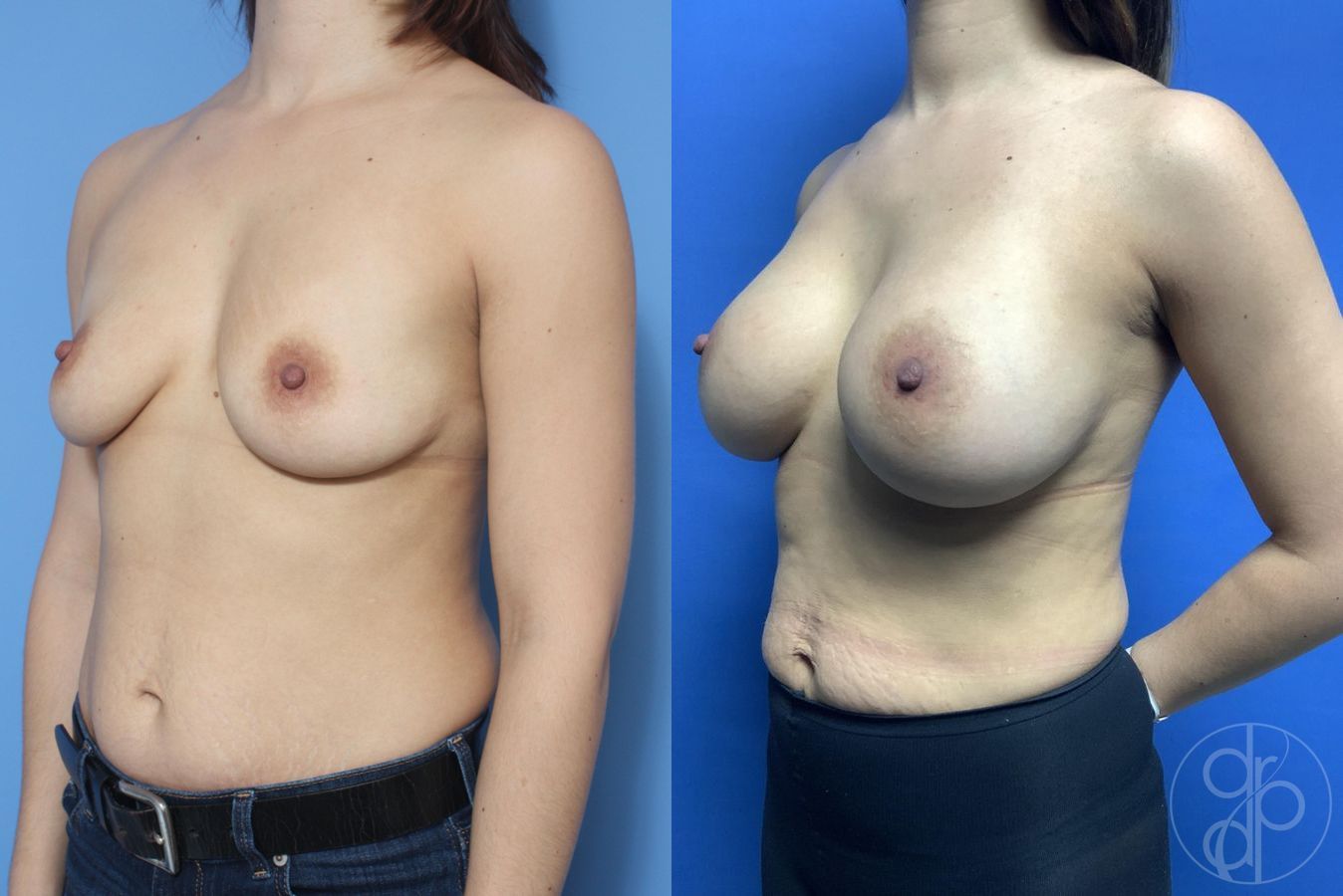 Before and after Breast Augmentation case 29817 - Angle 3