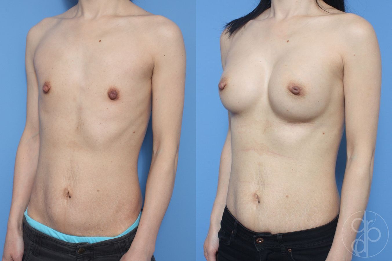 Before and after Breast Augmentation case 29907 - Angle 3
