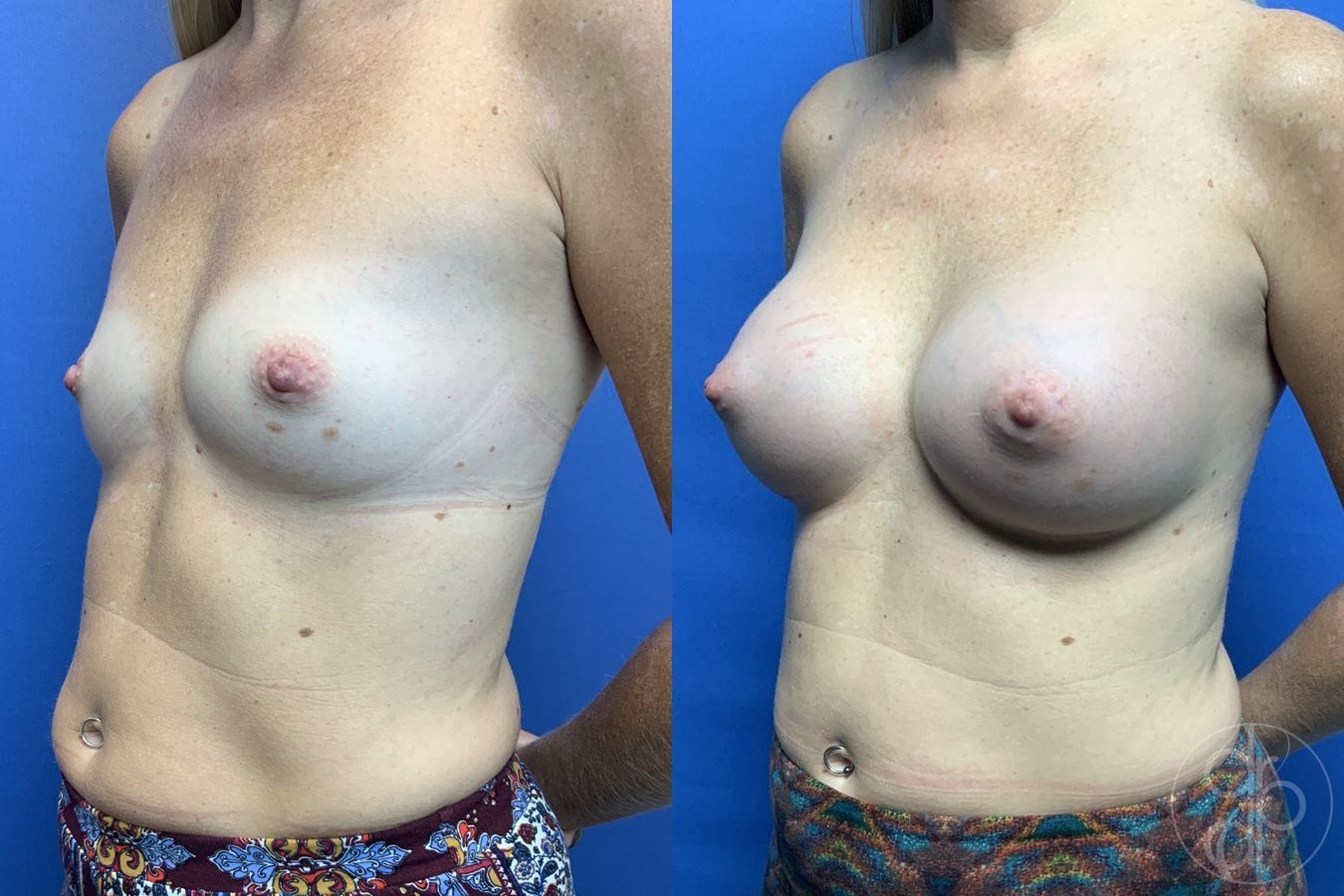 Before and after Breast Augmentation case 29960 - Angle 3