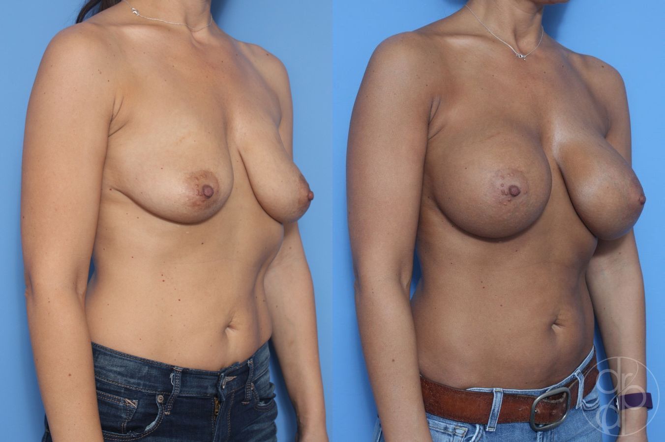 Before and after Breast Augmentation case 29916 - Angle 2