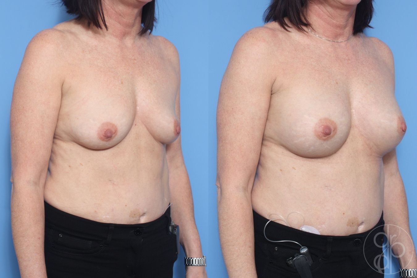 Before and after Breast Augmentation case 29905 - Angle 3