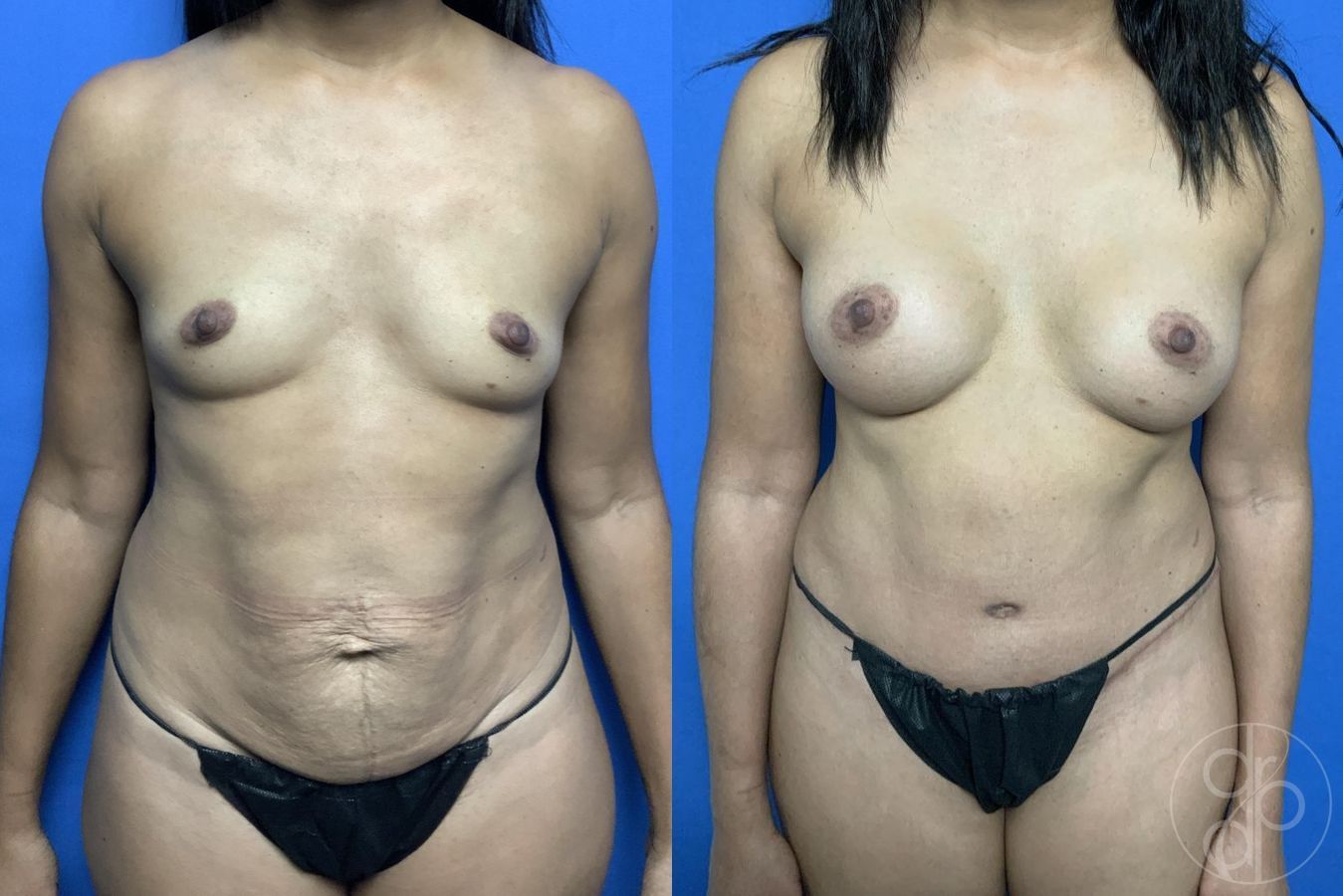 Before and after Mommy Makeover case 29732