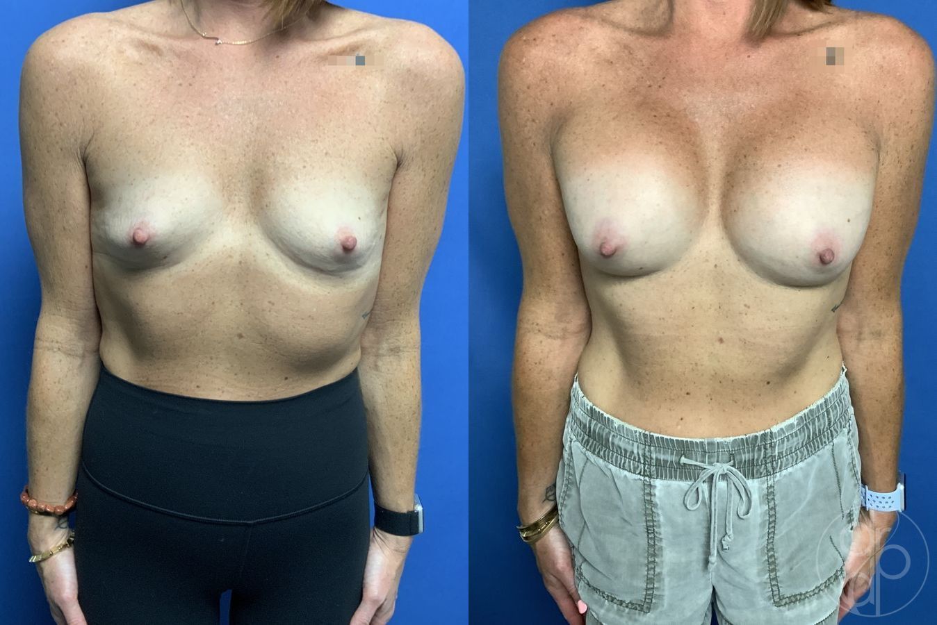 Before and after Breast Augmentation case 29838