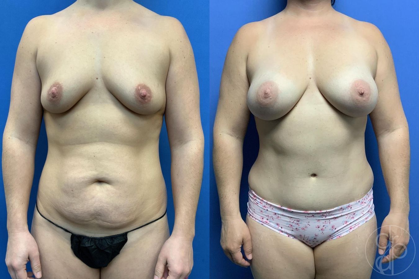 Before and after Mommy Makeover case 29728