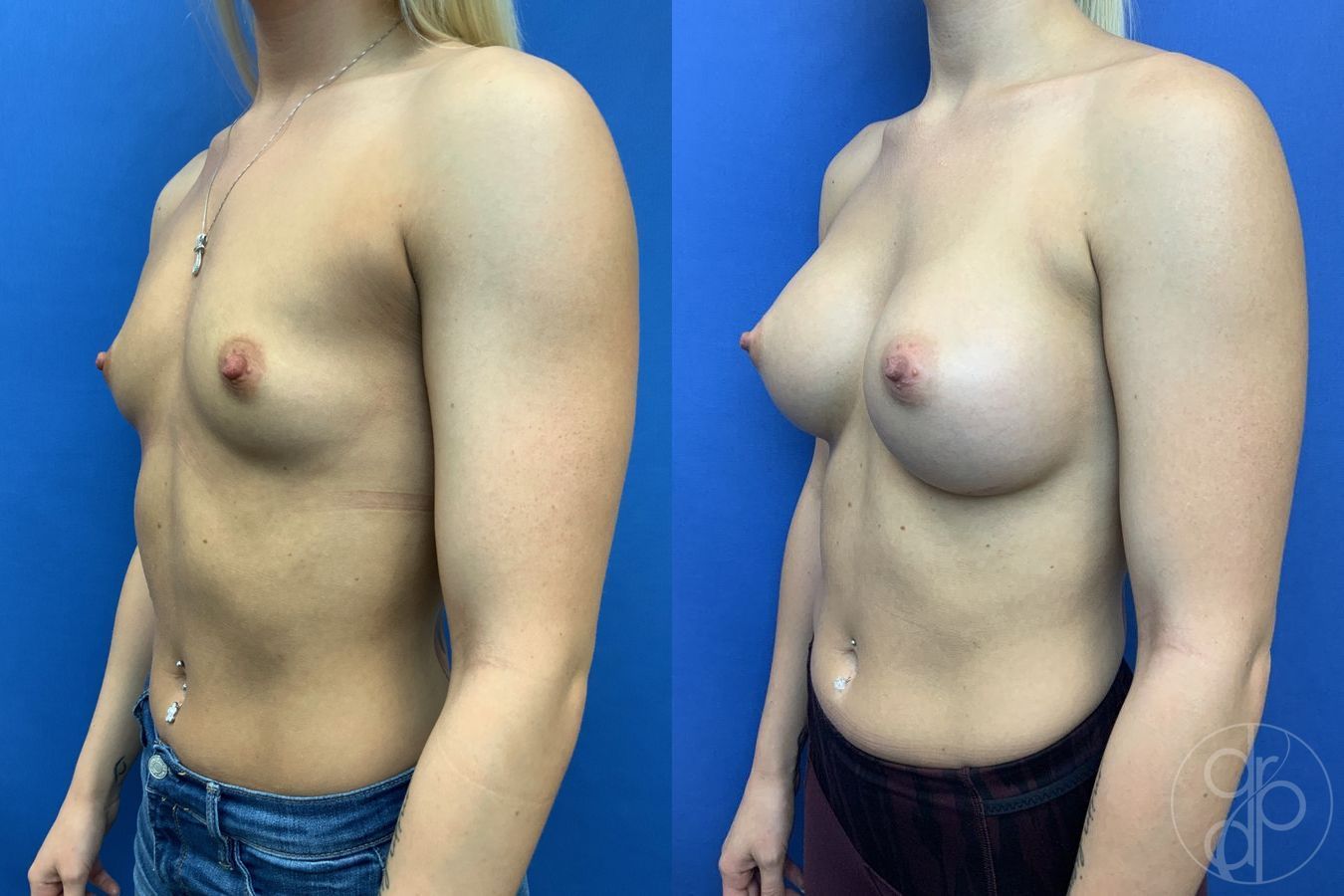 Breast Augmentation - Thumbnail 3