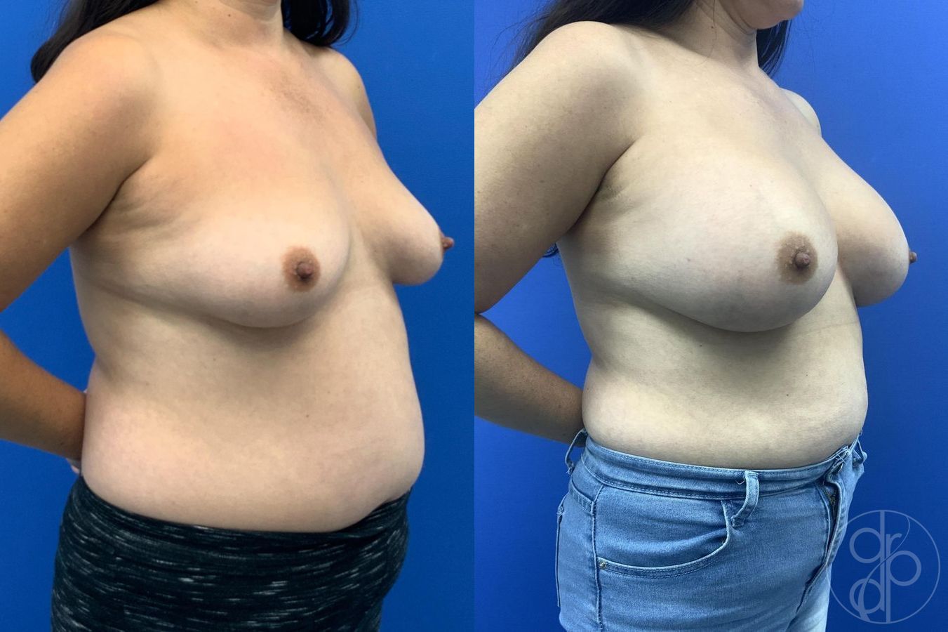 Before and after Breast Augmentation case 29611 - Angle 4