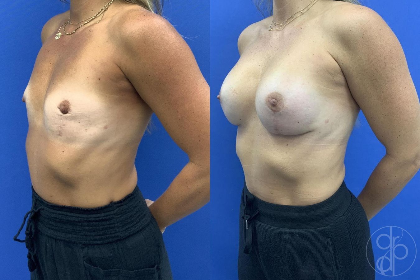 Before and after Breast Augmentation case 29617 - Angle 4