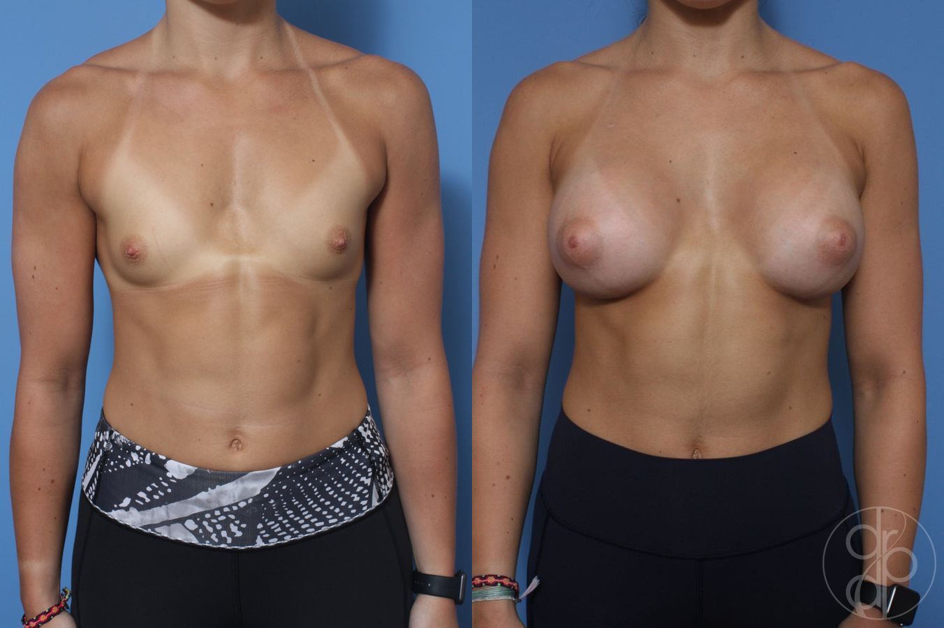 Before and after Breast Augmentation case 29831