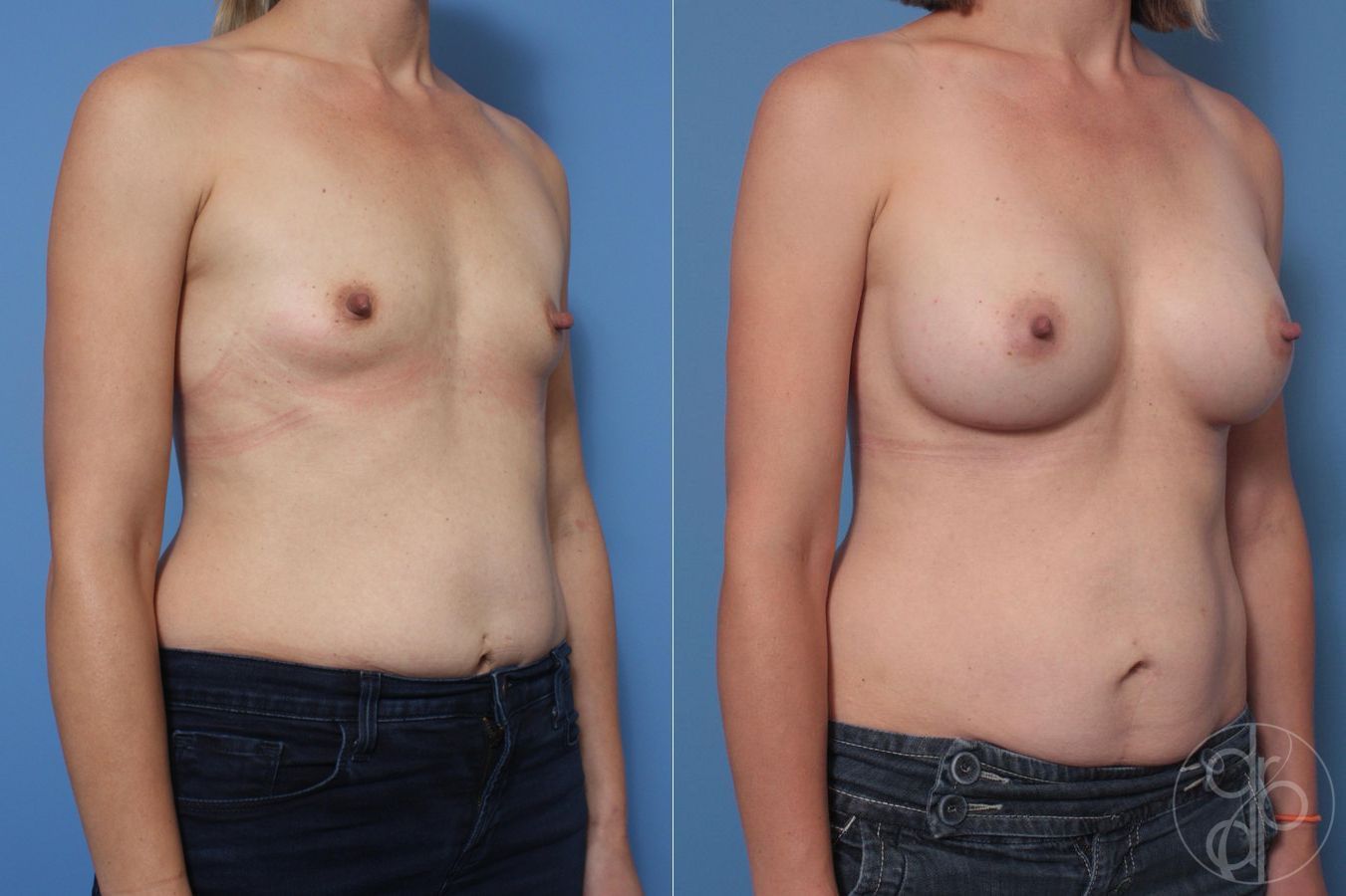Before and after Breast Augmentation case 29644 - Angle 4