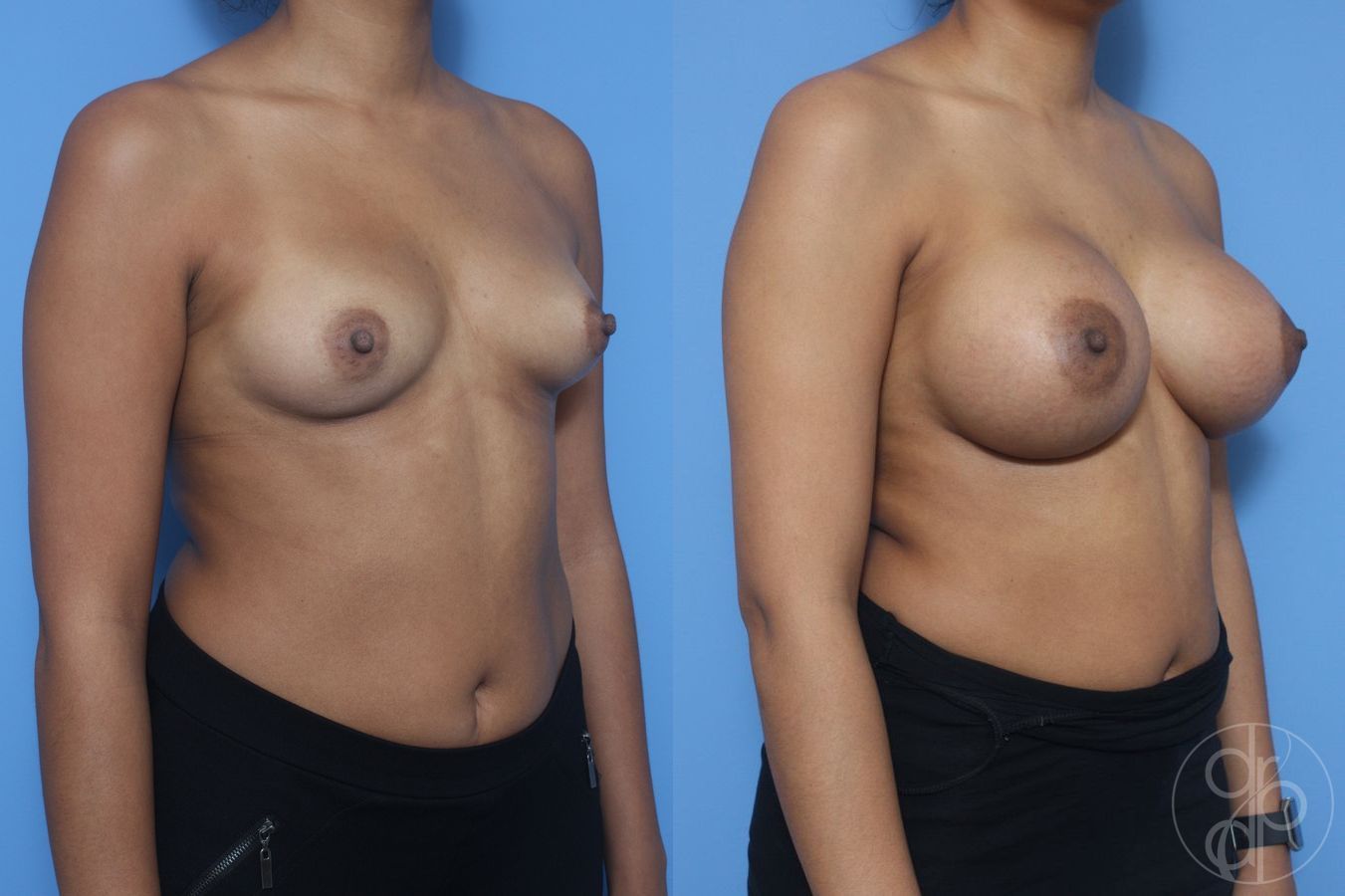Breast Augmentation - Thumbnail 3