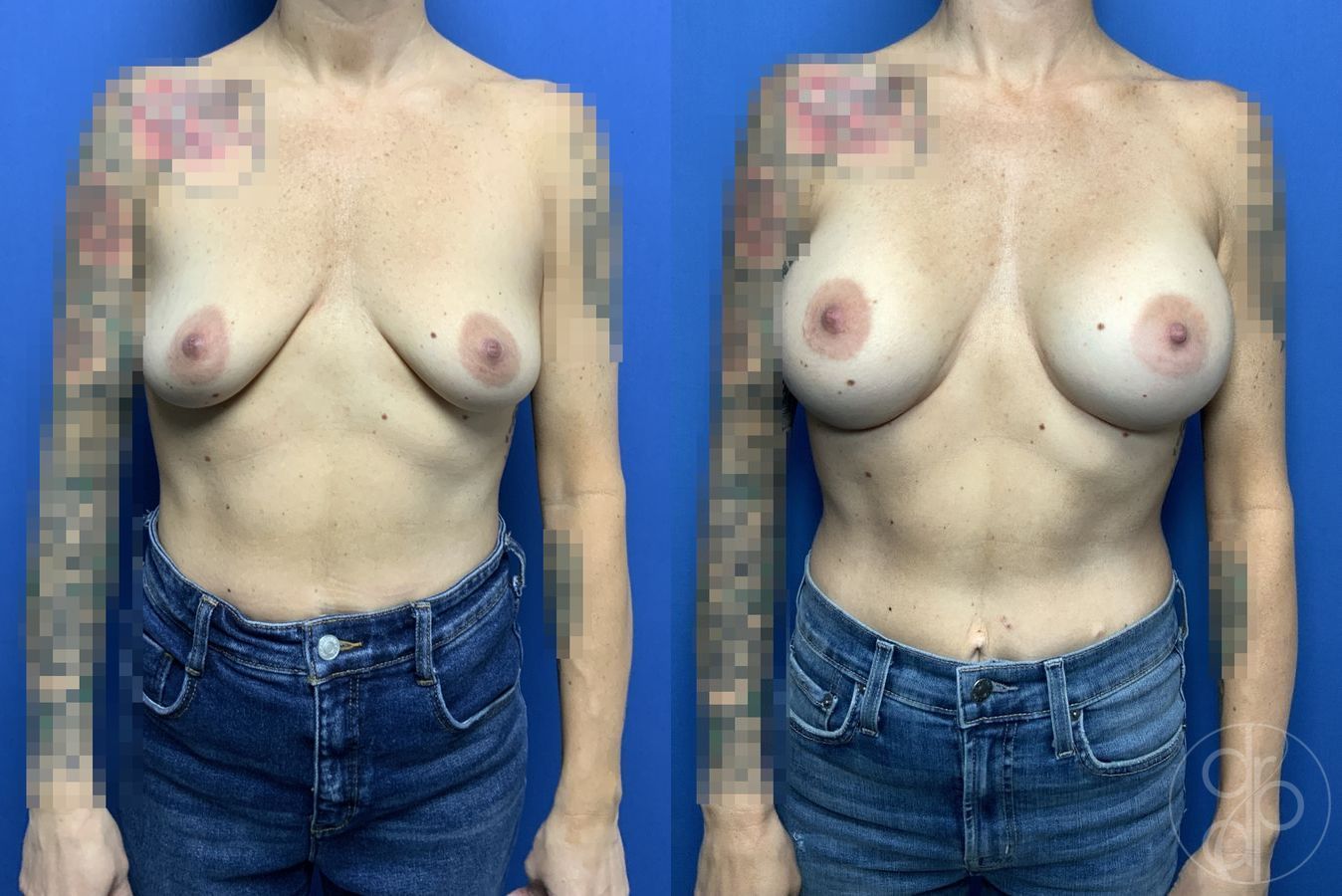 Before and after Breast Augmentation case 29929