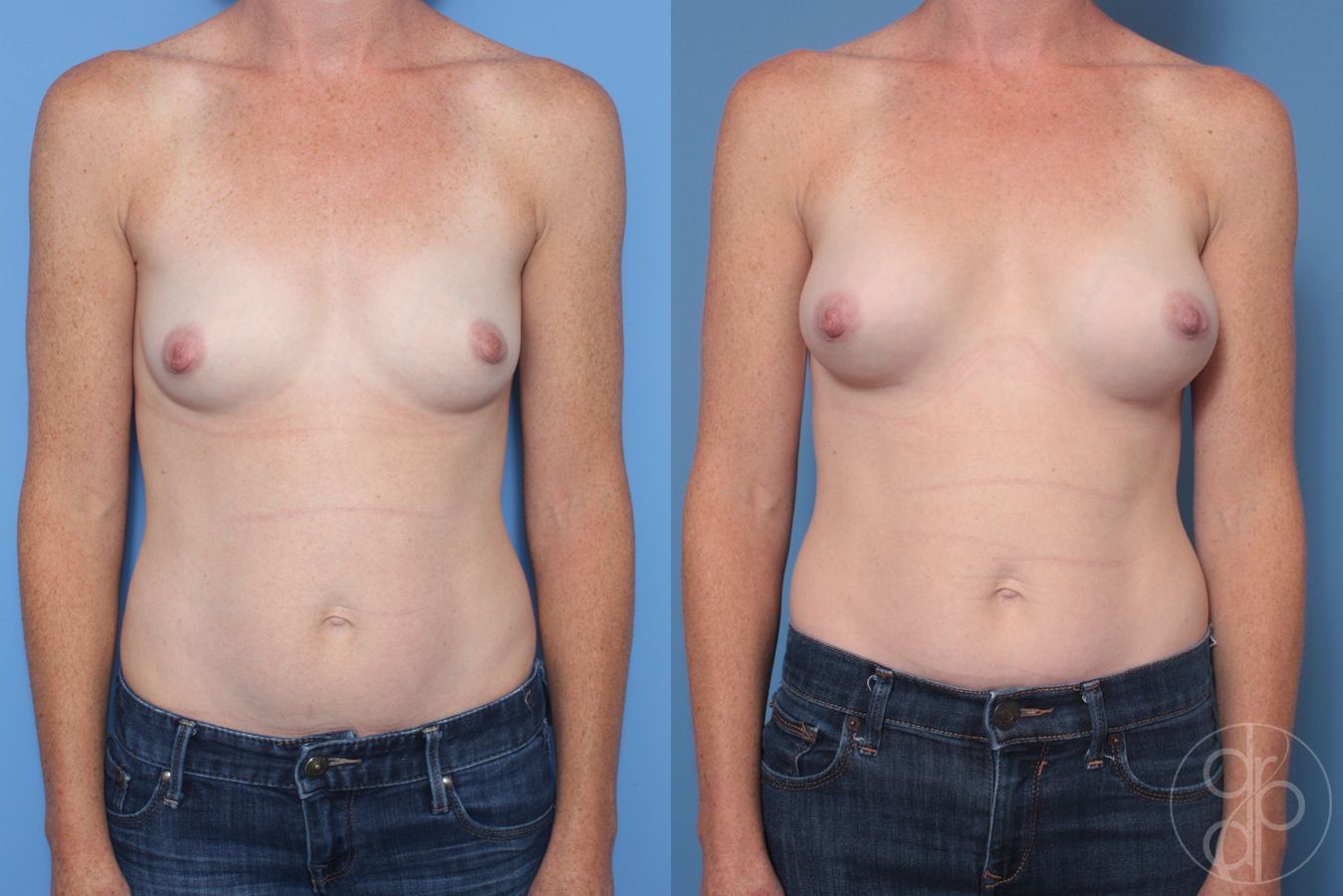 Before and after Breast Augmentation case 29936