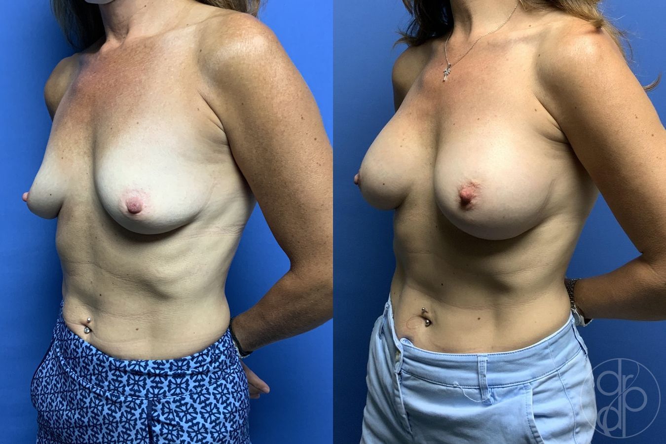 Before and after Breast Augmentation case 29792 - Angle 3