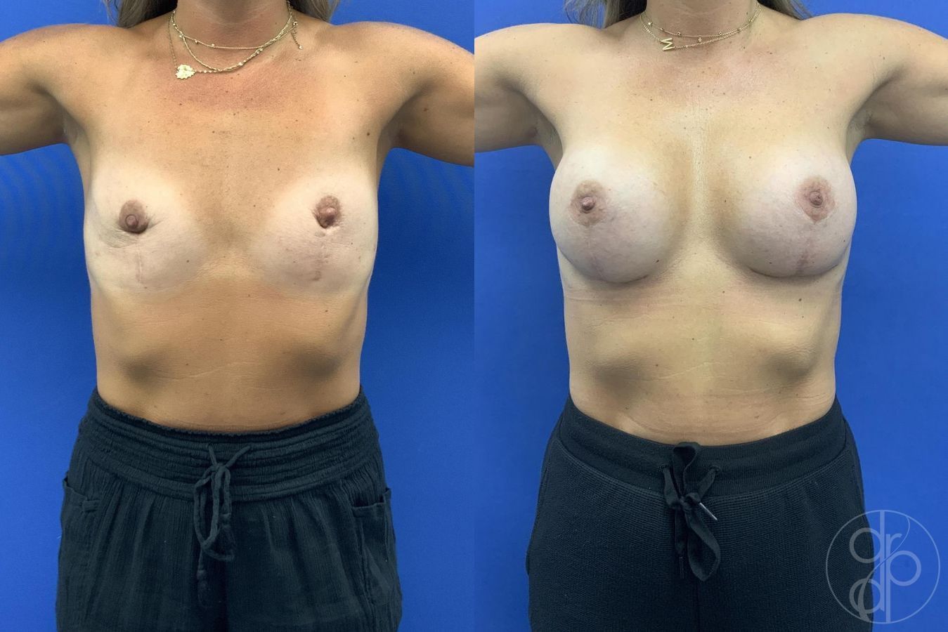 Before and after Breast Augmentation case 29617 - Angle 2