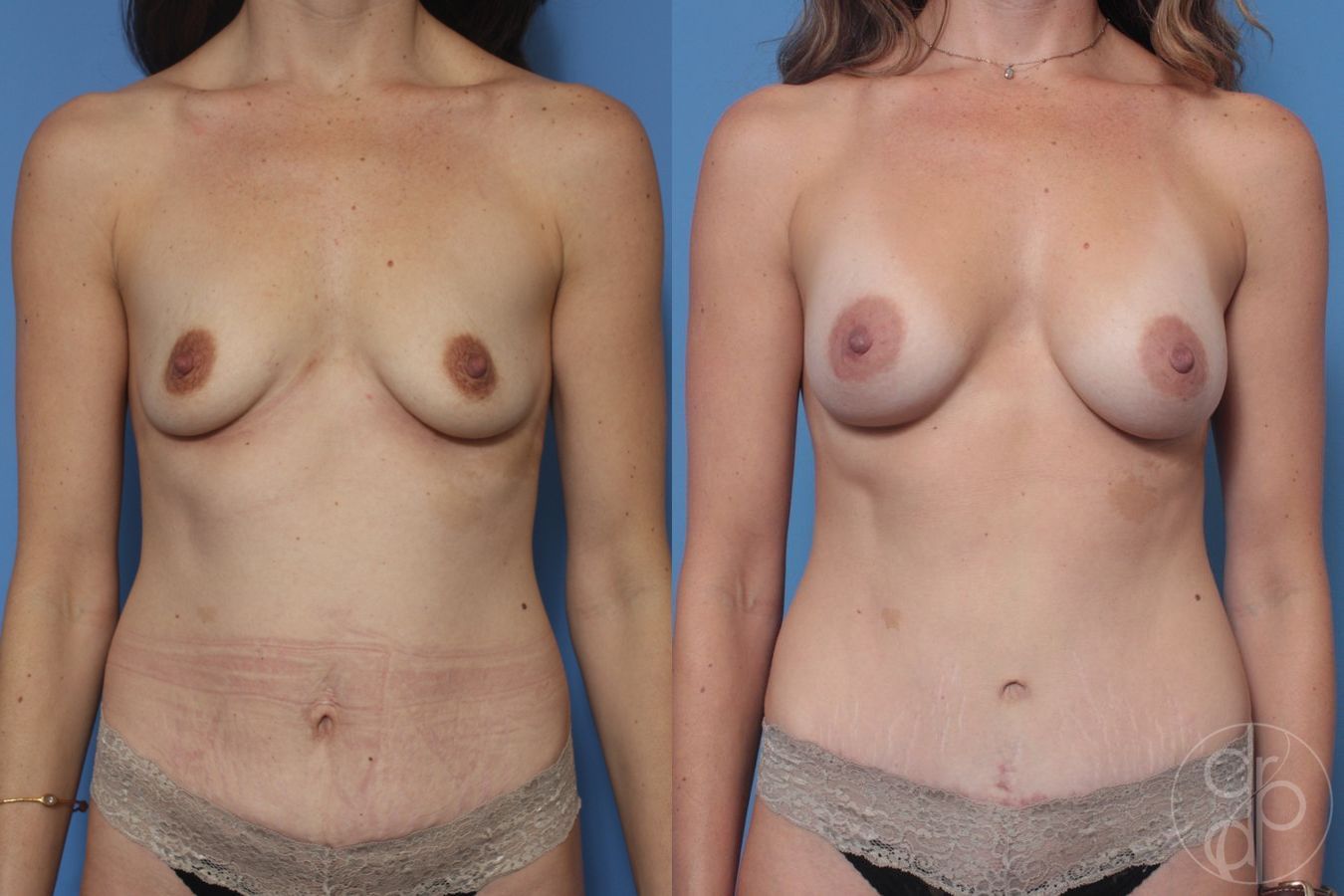 Before and after Mommy Makeover case 29733