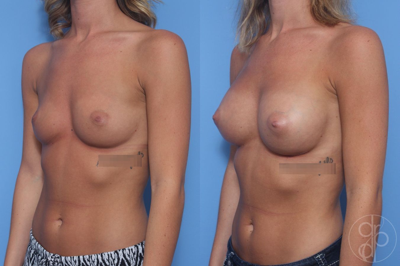 Before and after Breast Augmentation case 29922 - Angle 3