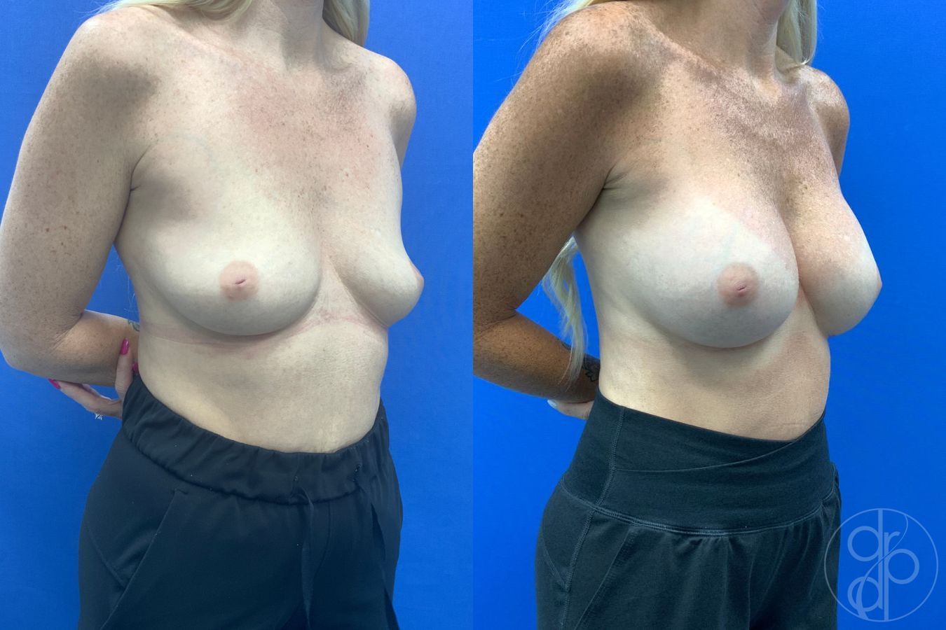 Before and after Breast Augmentation case 46357 - Angle 3