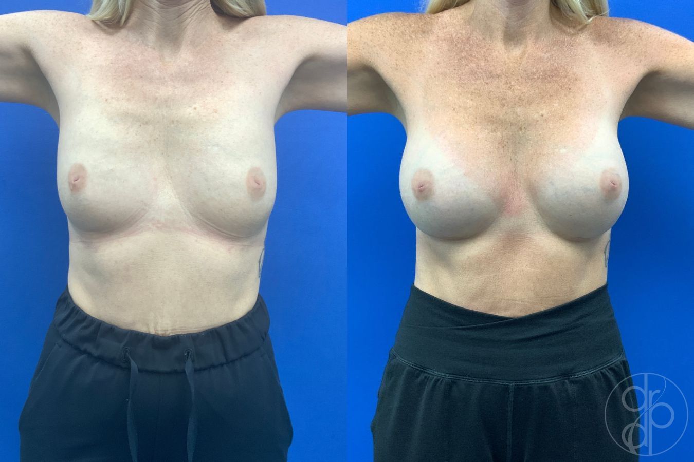 Before and after Breast Augmentation case 46357 - Angle 2