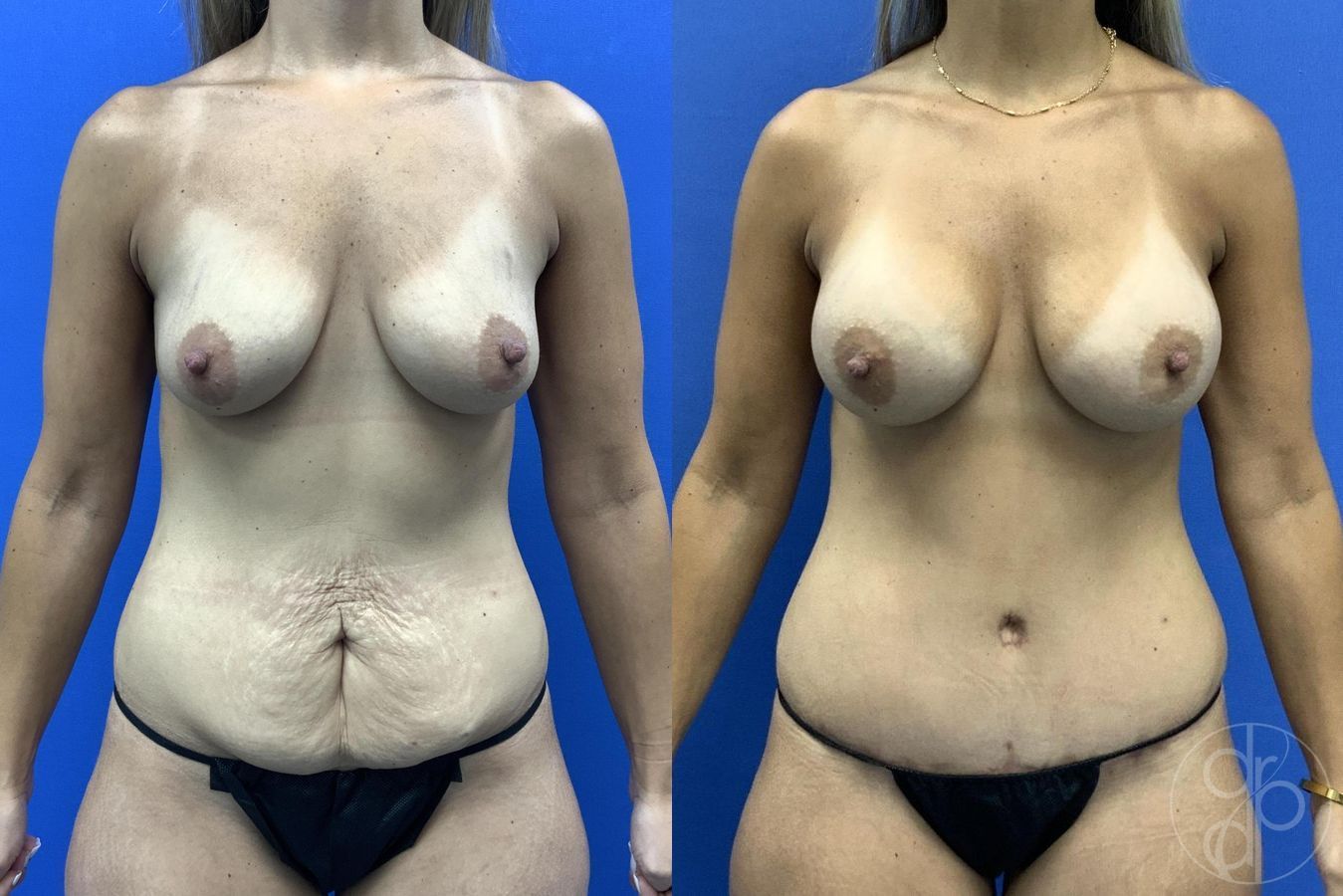 Before and after Breast Augmentation case 29723