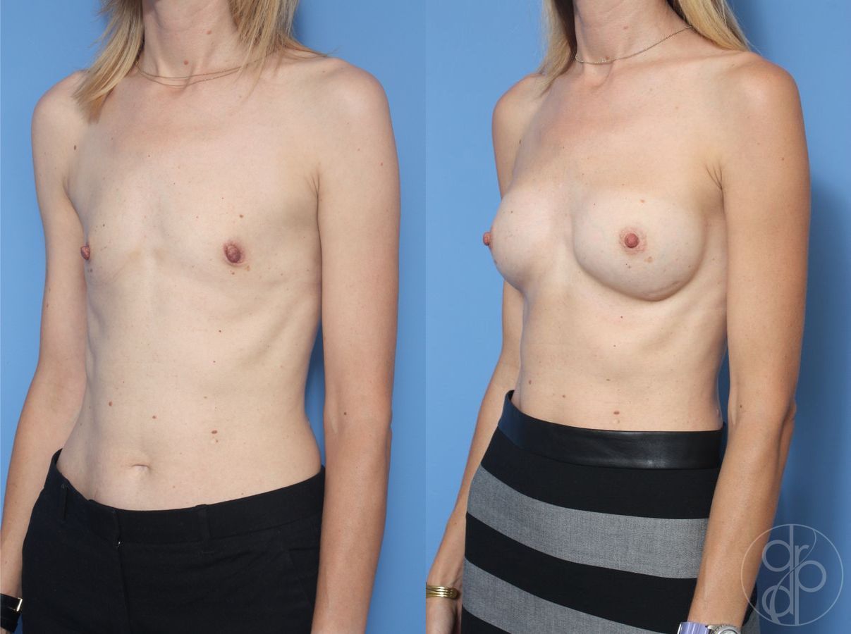 Before and after Breast Augmentation case 29921 - Angle 3