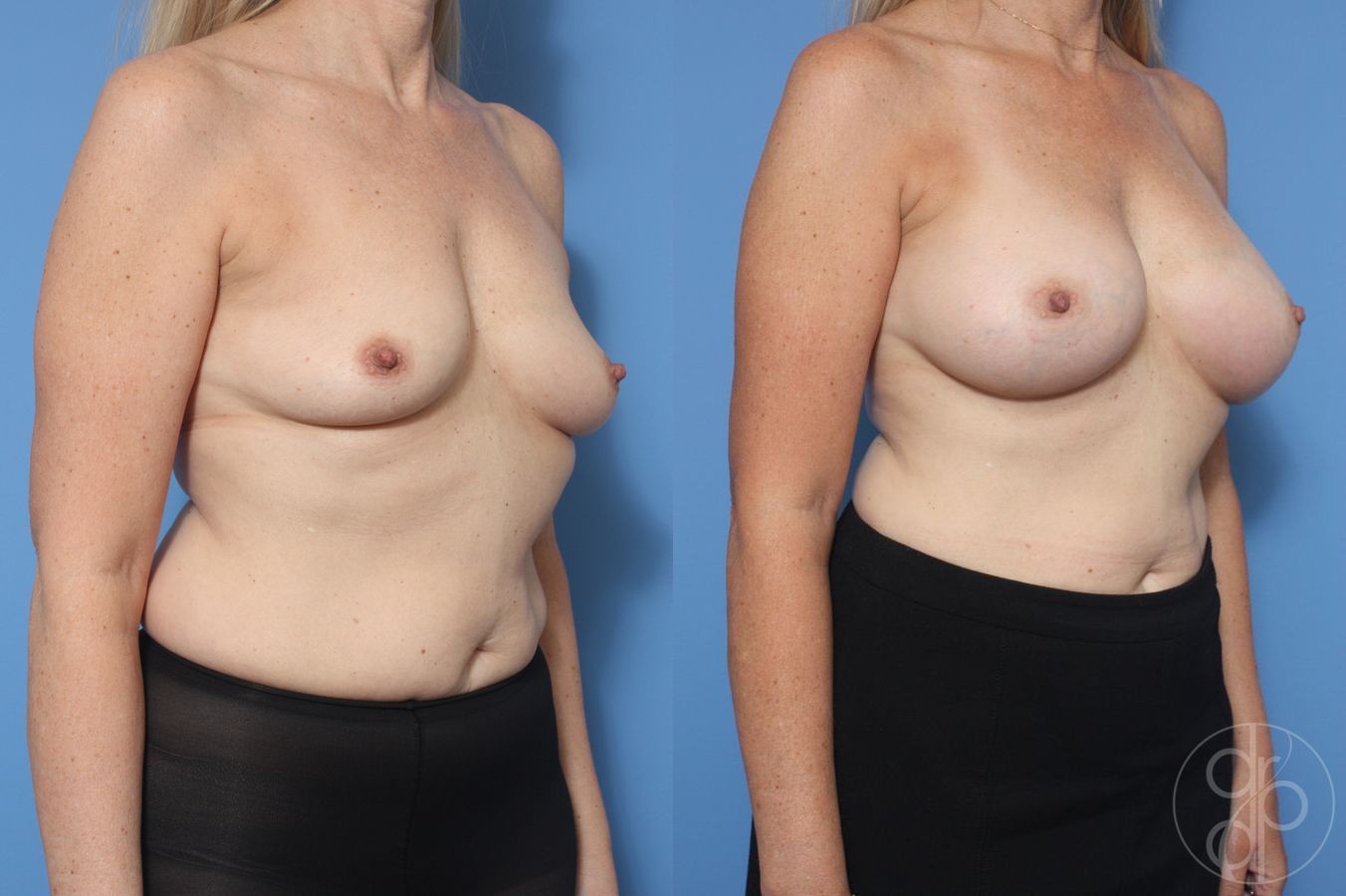 Before and after Breast Augmentation case 29917 - Angle 3