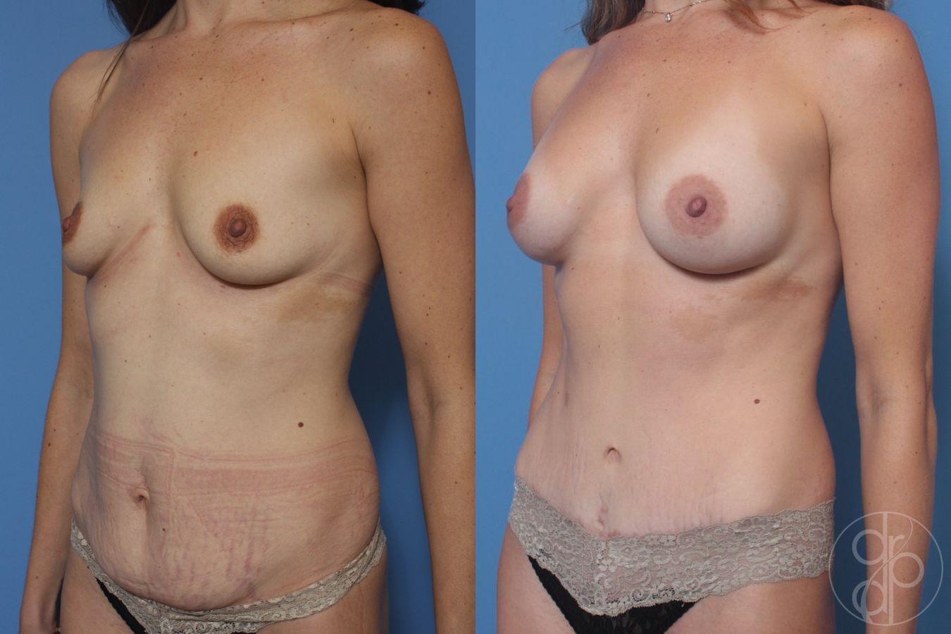 Before and after Mommy Makeover case 29733 - Angle 3