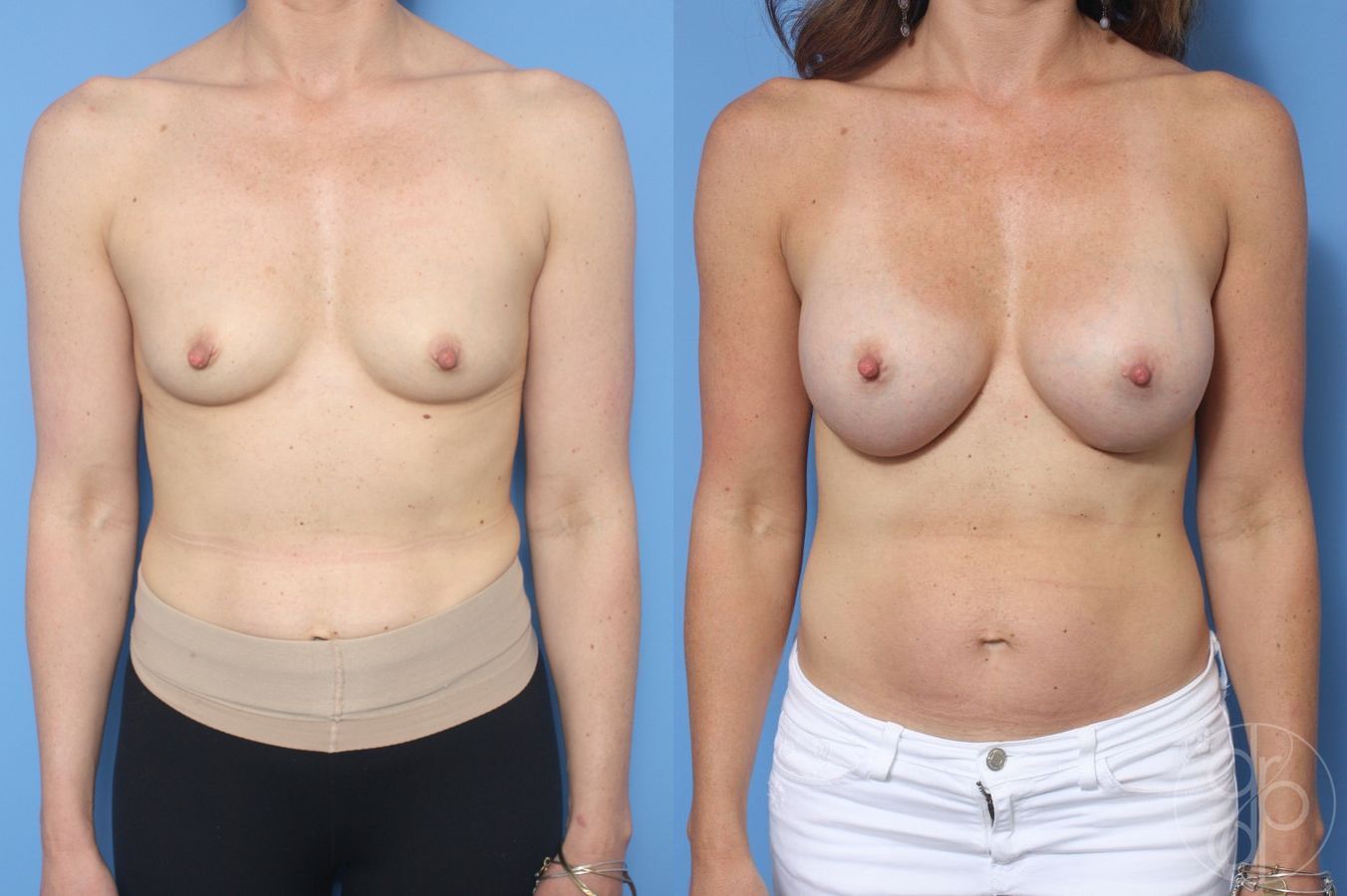 Breast Augmentation - Case 427