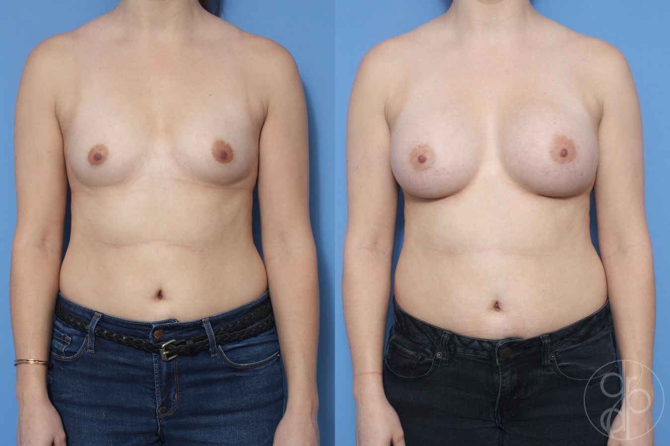Before and after Breast Augmentation case 29953