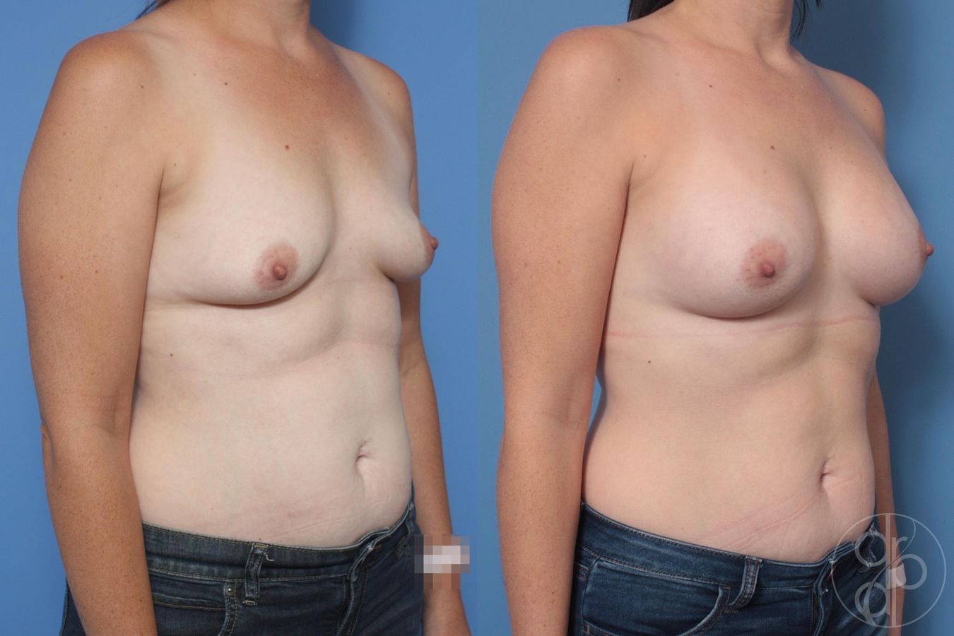 Before and after Breast Augmentation case 29998 - Angle 3