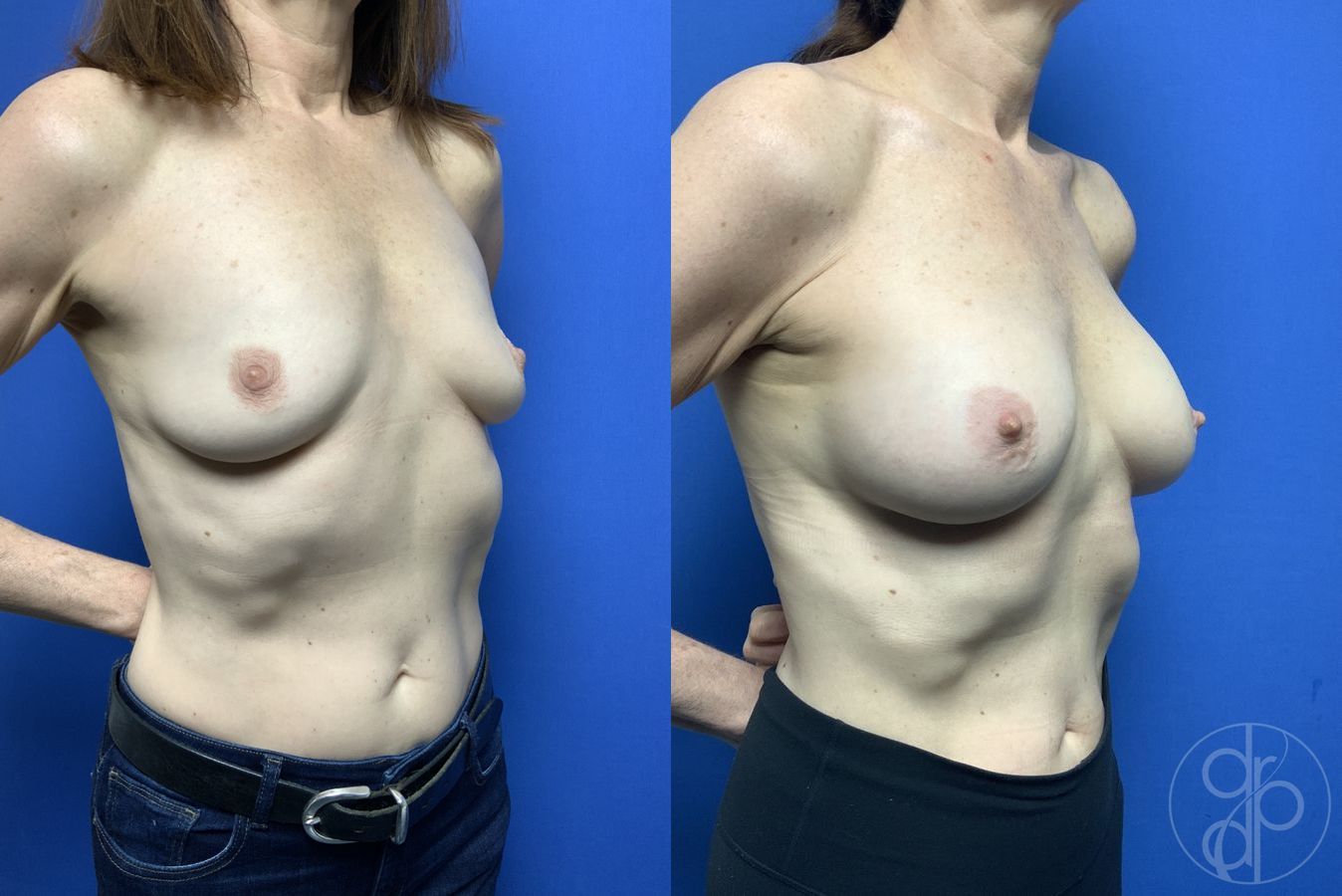 Before and after Breast Augmentation case 29918 - Angle 2