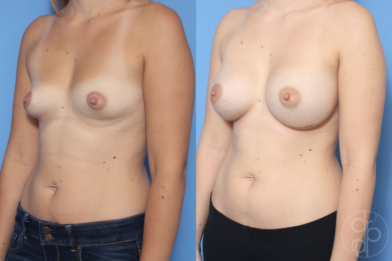Before and after Breast Augmentation case 29875 - Angle 2