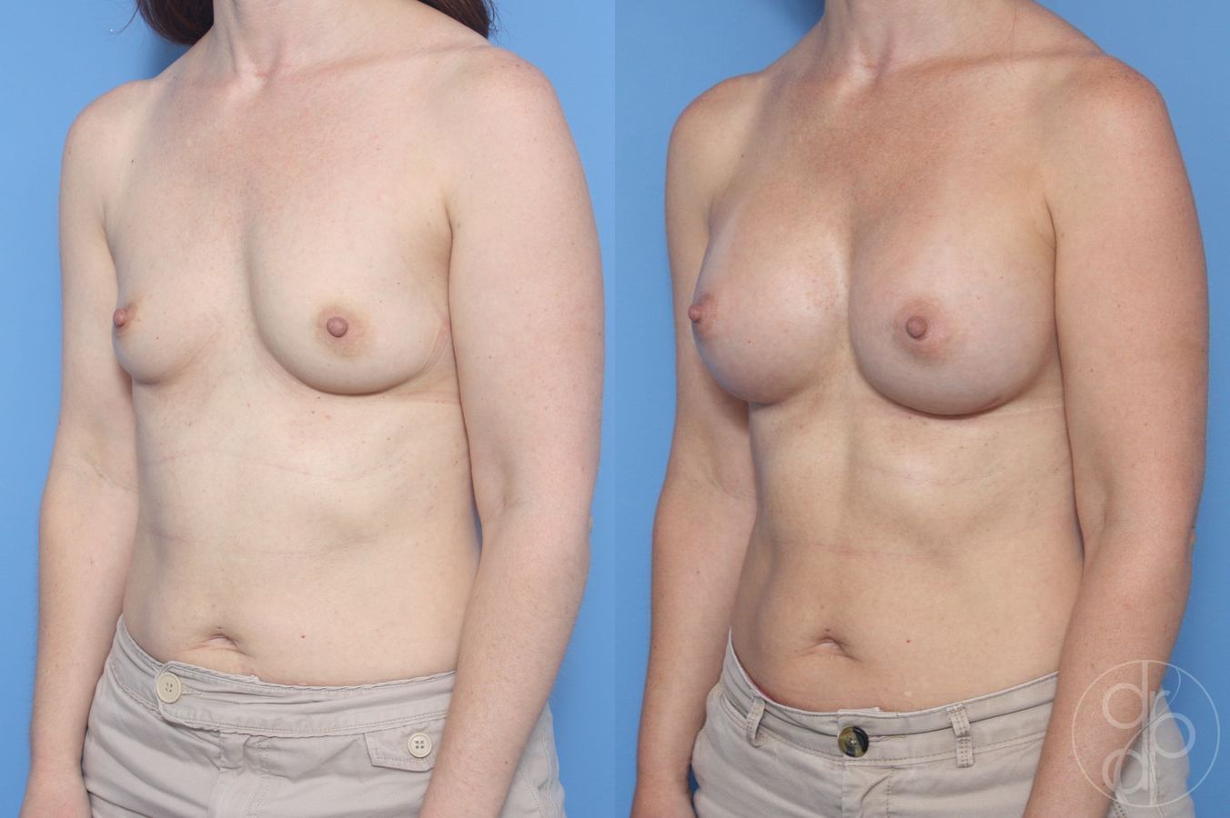 Before and after Breast Augmentation case 29945 - Angle 3
