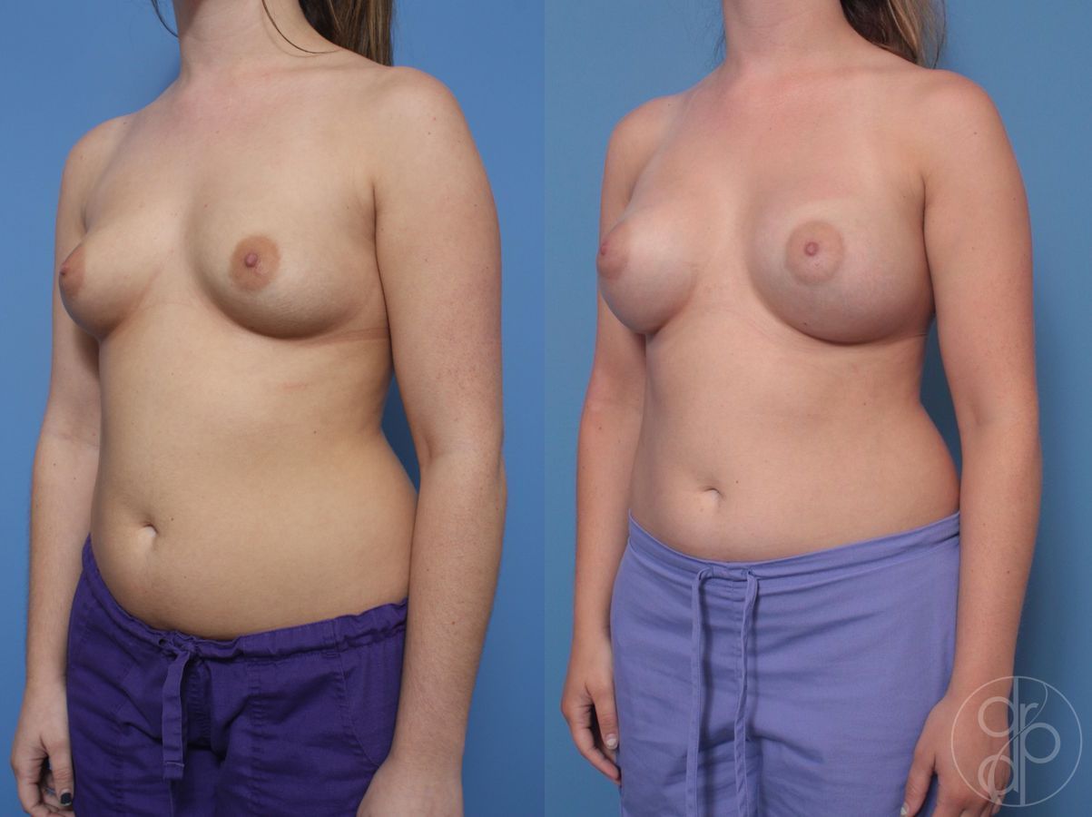 Breast Augmentation - Thumbnail 3
