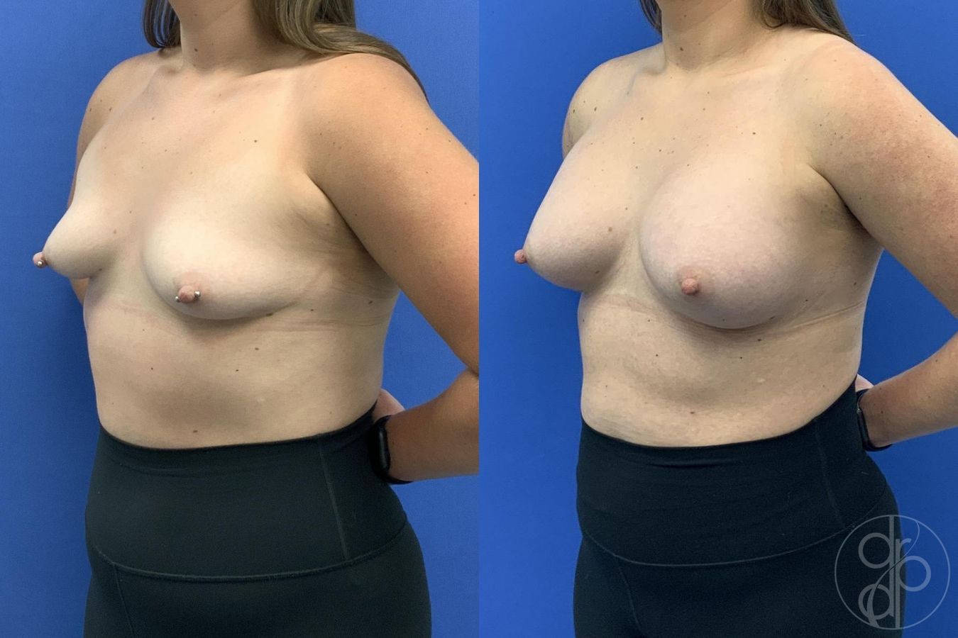 Before and after Breast Augmentation case 30024 - Angle 4