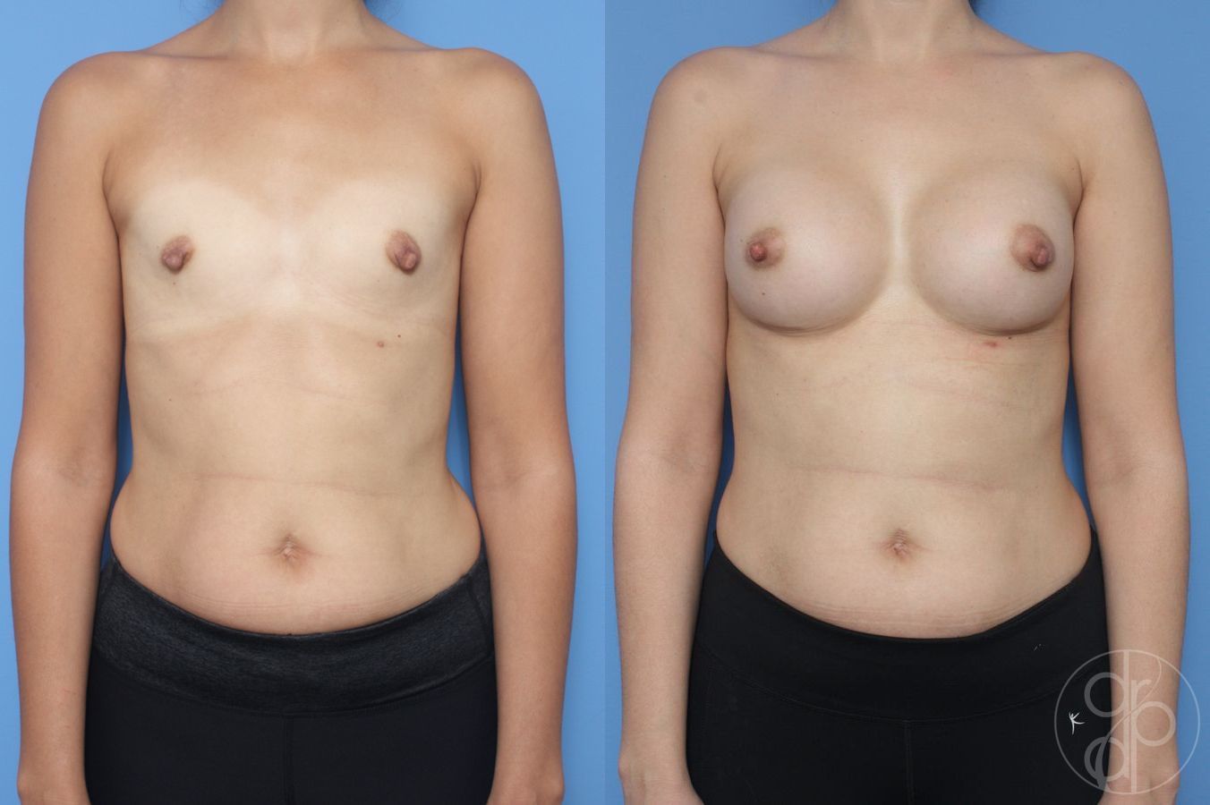 Before and after Breast Augmentation case 29952