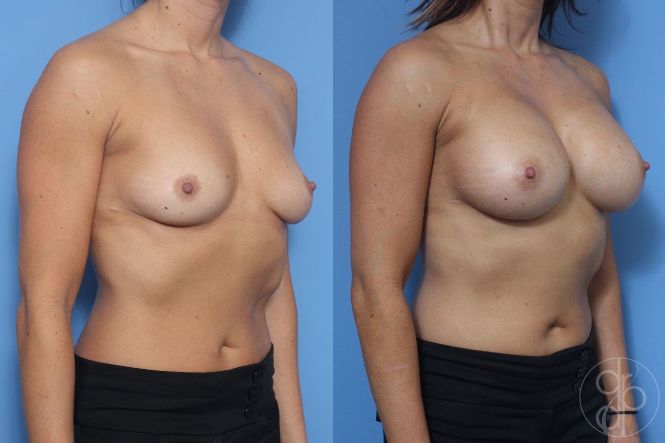 Before and after Breast Augmentation case 29947 - Angle 3