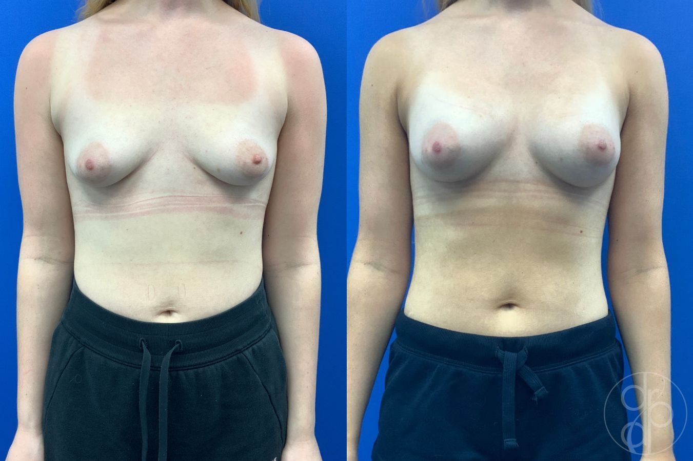 Before and after Tubular Breast Surgery case 46765