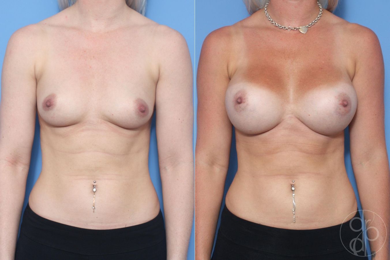 Before and after Breast Augmentation case 29616
