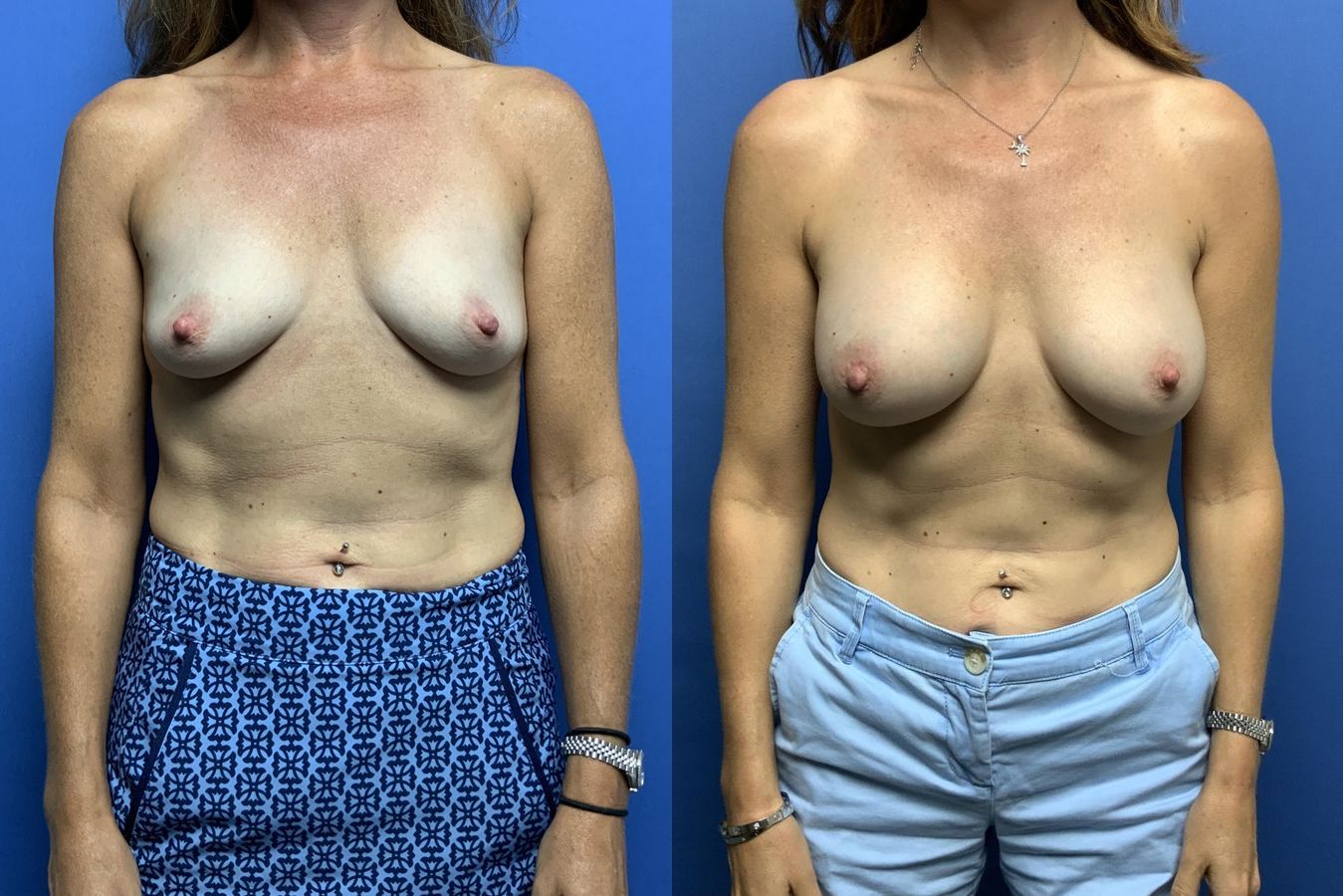 Breast Augmentation - Case 467