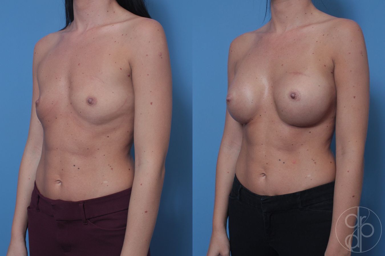 Breast Augmentation - Thumbnail 3
