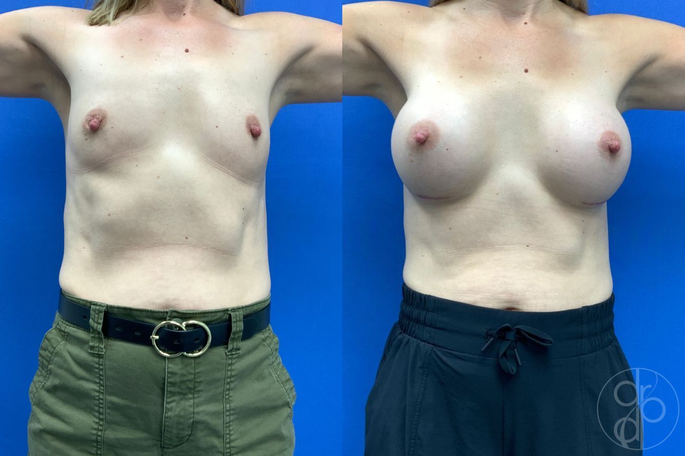 Before and after Breast Augmentation case 49410 - Angle 2