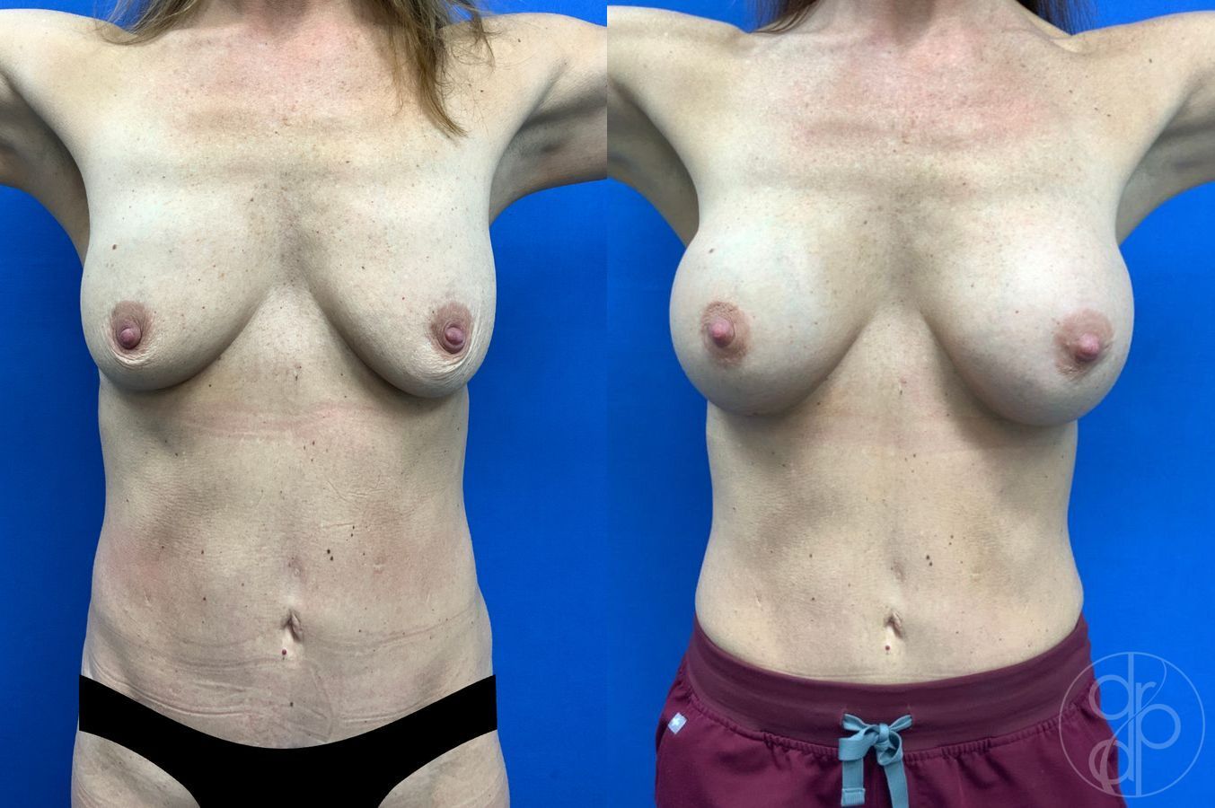 Before and after Breast Augmentation case 49416 - Angle 2